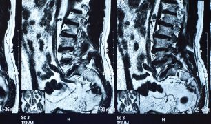 Slider-MRI-Spine-02